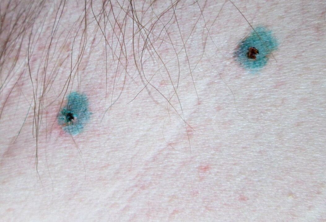 Белези по кожата след лазерно отстраняване на папиломи