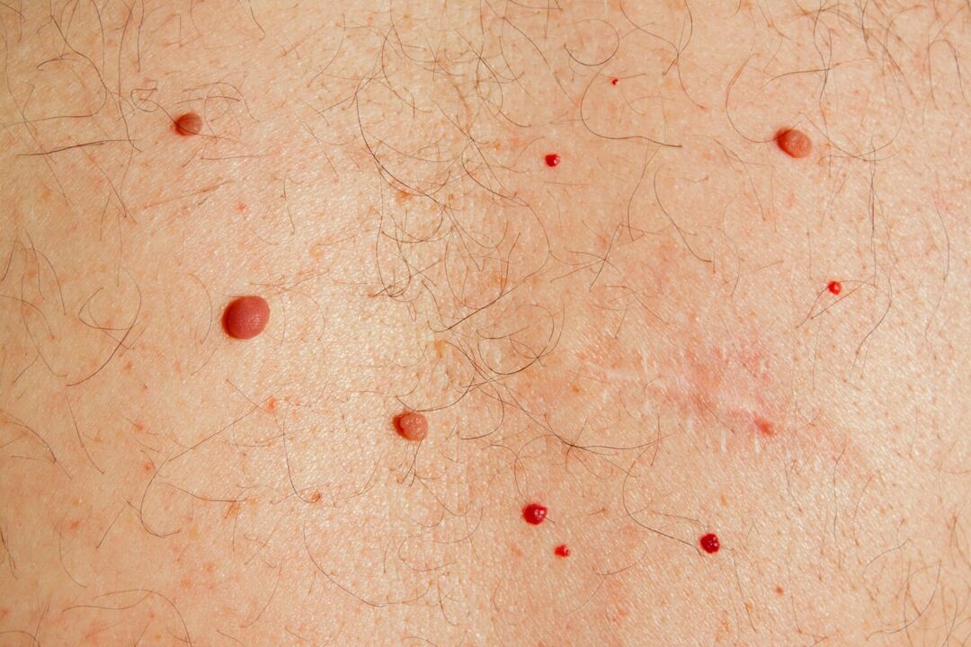 Папиломи по тялото, причинени от HPV